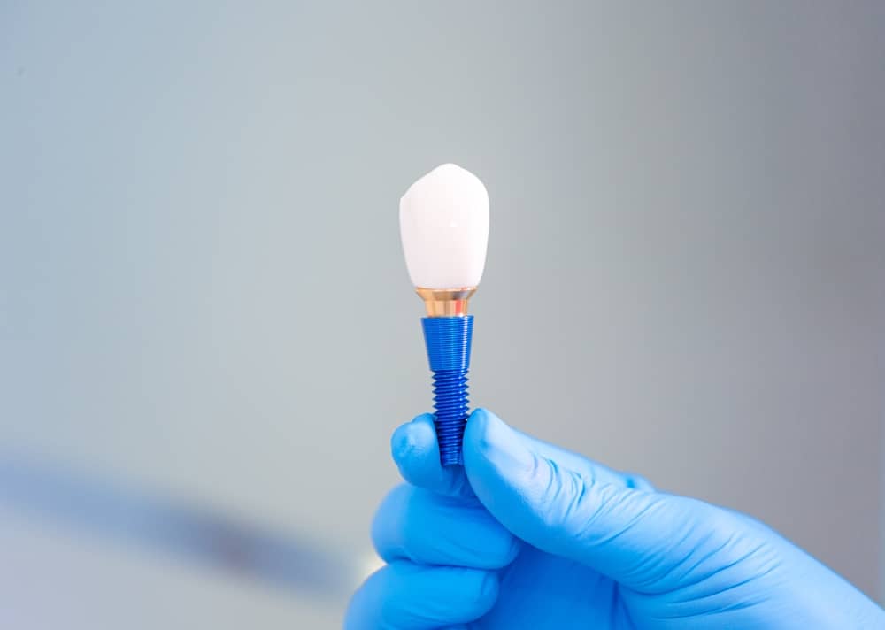 Dental Implants in Miami FL